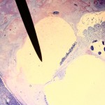 Vacuna Contra el VPH Y Revisiones Periodicas las Mejores Armas Contra el Cáncer Cervico Uterino: GTC